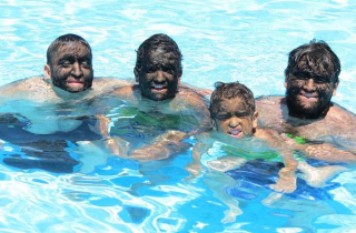 “Người sói” hiện đại và hội chứng kỳ dị nhất hành tinh