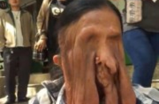 Căn bệnh lạ khiến cụ bà 63 chảy xệ mặt đến biến dạng