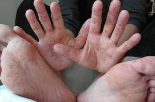 Tại sao bệnh tay chân miệng tăng cao mùa tựu trường?