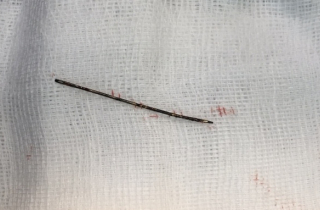 Kim chạy từ lưng xuyên qua phổi bé 3 tuổi