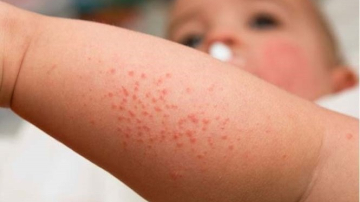 Vừa khống chế sốt xuất huyết, Hà Nội lại có 1 ca tử vong do sởi