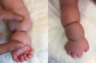 Bé gái bị thắt vòng tay bẩm sinh hiếm gặp