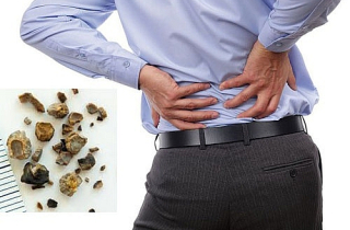 Những ai có nguy cơ mắc sỏi thận?