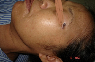 Có thể mất mạng chỉ vì một chấm đen trên da