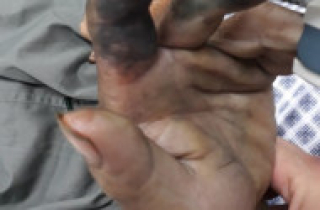 Hoại tử ngón tay do đắp thuốc nam sau khi bị rắn cắn