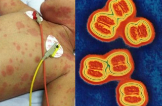 Những điều cần biết để phòng tránh bệnh viêm não mô cầu đang có nguy cơ bùng phát