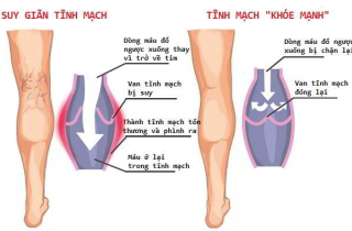 Đứng làm việc 8 giờ mỗi ngày, nữ điều dưỡng mắc bệnh không ngờ