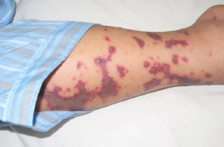 Thiếu nữ 18 tuổi ở Hà Nội bị cách ly do viêm não mô cầu