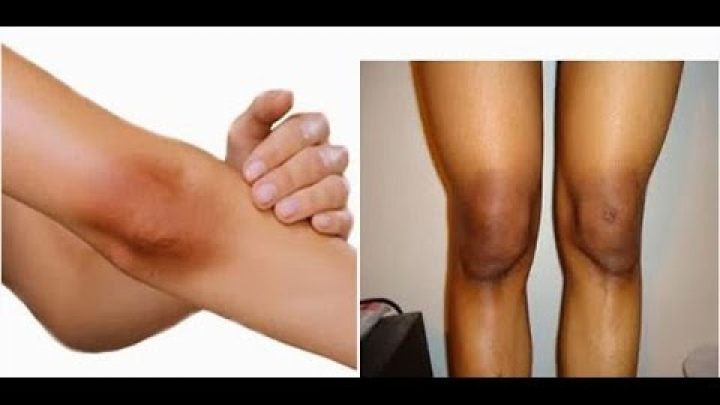 Bị bạn trai chia tay chỉ vì đầu gối thâm