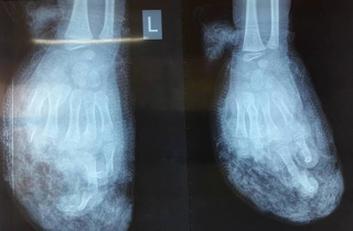 Điện thoại đang sạc pin phát nổ làm dập nát bàn tay bé trai