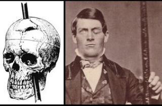 Dầm sắt xuyên đầu và bí ẩn kinh điển nhất nền y học nhân loại