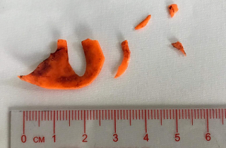 Bác sĩ mổ bất ngờ phát hiện miếng nhựa xuyên đường thở bé trai