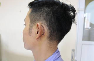 Điện thoại đang sạc phát nổ làm thủng màng nhĩ nam thanh niên