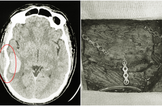 Va chạm mạnh khi đá bóng, cầu thủ bị vỡ xương sọ