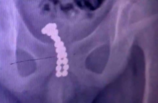 Cậu bé tự nhét 26 viên bi vào dương vật