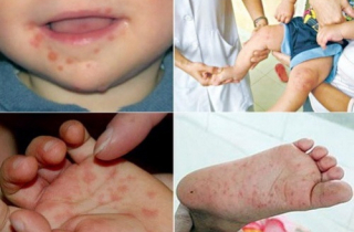 Cảnh giác bệnh tay chân miệng mùa tựu trường