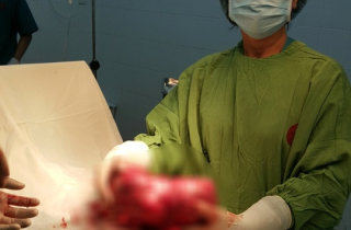 Bụng to như thai 8 tháng, bóc ra u xơ 2,5 kg