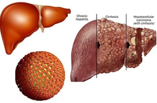 Những thắc mắc thường thấy về bệnh viêm gan B