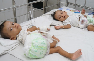 Một trong hai bé song sinh dính liền bị nhiễm trùng phải mổ lại