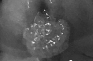 Bé trai 2 tuổi ở Hà Nội mắc sùi mào gà