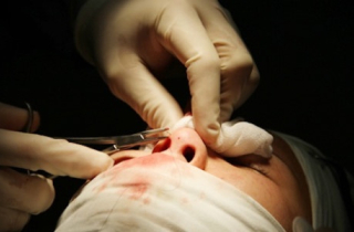 Chỉ phẫu thuật 6 năm chui ra từ mũi