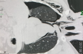 Chàng trai gãy xương sườn mà không biết