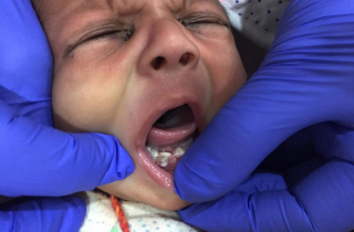 Hy hữu: Bé sơ sinh vừa chào đời đã mọc 7 cái răng