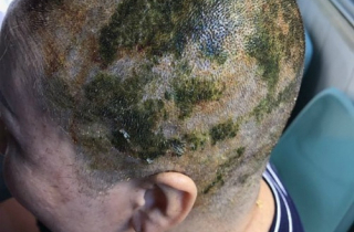 Người phụ nữ bị bỏng da đầu sau khi nhuộm tóc