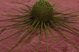 Những dấu hiệu cảnh báo sớm bạn bị ung thư lưỡi