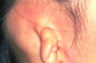 Bé trai 8 tuổi ở Hà Nội được tạo hình tai mới