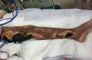 Chân hoại tử bốc mùi hôi thối vì tin \'bác sĩ google\' hơn bác sĩ thật