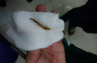 Bị xương ếch đâm thủng đại tràng, nam thanh niên nhập viện cấp cứu