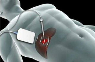 Lần đầu cắt u gan không cần mở ổ bụng