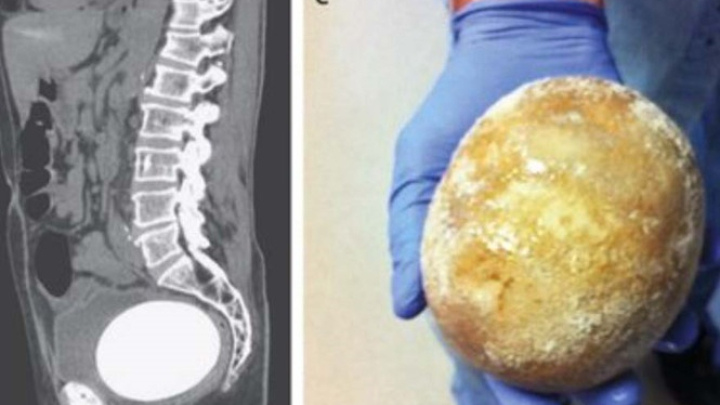 Viên sỏi bàng quang to bằng trứng đà điểu