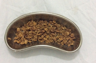 Hạt sơ ri nảy mầm trong ruột bé trai gây tắc hậu môn