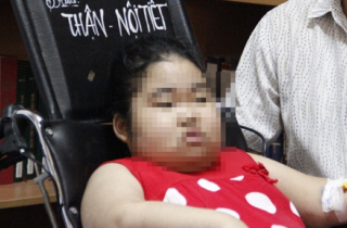 Bé gái mặt tròn như trăng do căn bệnh chỉ 20 người trên thế giới mắc