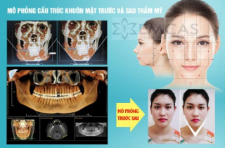 Thiếu phụ Sài Gòn hôn mê sau phẫu thuật gọt hàm