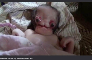 Cha mẹ em bé dị dạng: \'Chúng tôi sẽ không bỏ con\'