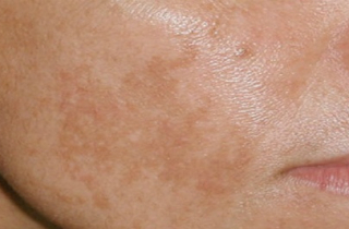 8 thủ phạm gây đổi màu da vùng mặt