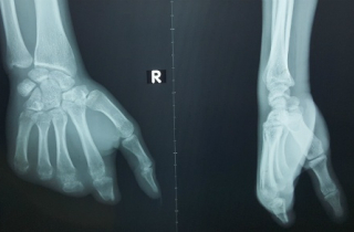 Lấy ngón chân ghép thành ngón tay cho nam công nhân