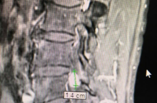 Suýt liệt vì khối u cột sống sau hơn 10 năm chữa đau lưng