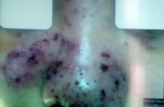 Đi làm đẹp dạo, thiếu nữ 17 tuổi suýt mất mũi