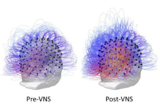 Hồi sinh não cho người sống thực vật 15 năm