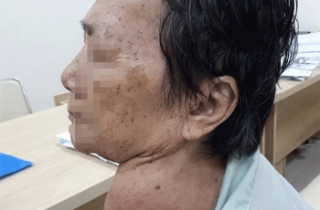 Khối u nặng hơn nửa kg ở cổ người phụ nữ