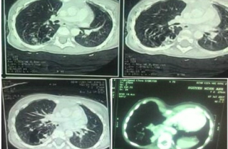 Bé gái có \'phổi biệt trí\'