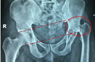 Chàng thanh niên đoạn tuyệt 30 năm khập khiễng sau 5 ngày điều trị