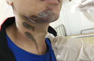 Bỏng nặng khi bị hóa chất tẩy rửa bồn cầu văng trúng