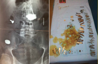 Người đàn ông nuốt hơn 100 miếng kim loại