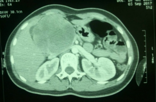 Tình huống bất ngờ khiến bác sĩ nhanh trí đổi cách mổ cứu bé gái