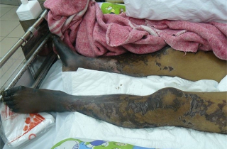 Người đàn ông suy đa tạng vì nghiện món khoái khẩu